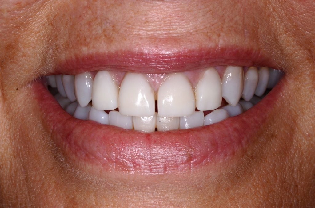 Direct Composite Veneers Direct composite veneers