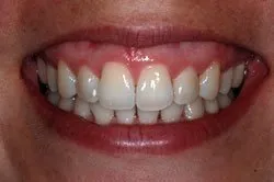 up-close image of patient's smile after dental treatment