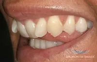Patient's smile before Six Month Smiles treatment