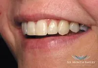 Patient's smile after Six Month Smiles treatment