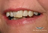 Patient's smile before Six Month Smiles treatment