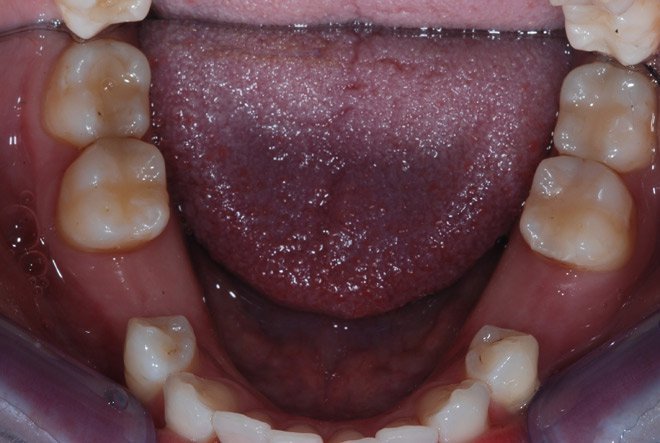 Patient's bottom teeth before dental implants