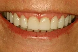 up-close image of patient's smile after dental treatment