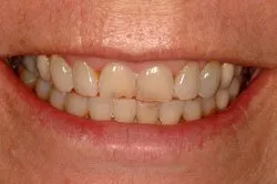 up-close image of patient's smile before dental treatment
