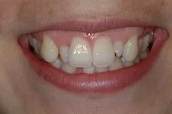 up-close image of patient's smile before dental treatment