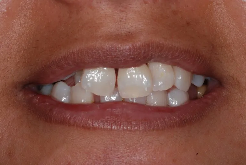 Before a Bridge example of missing teeth