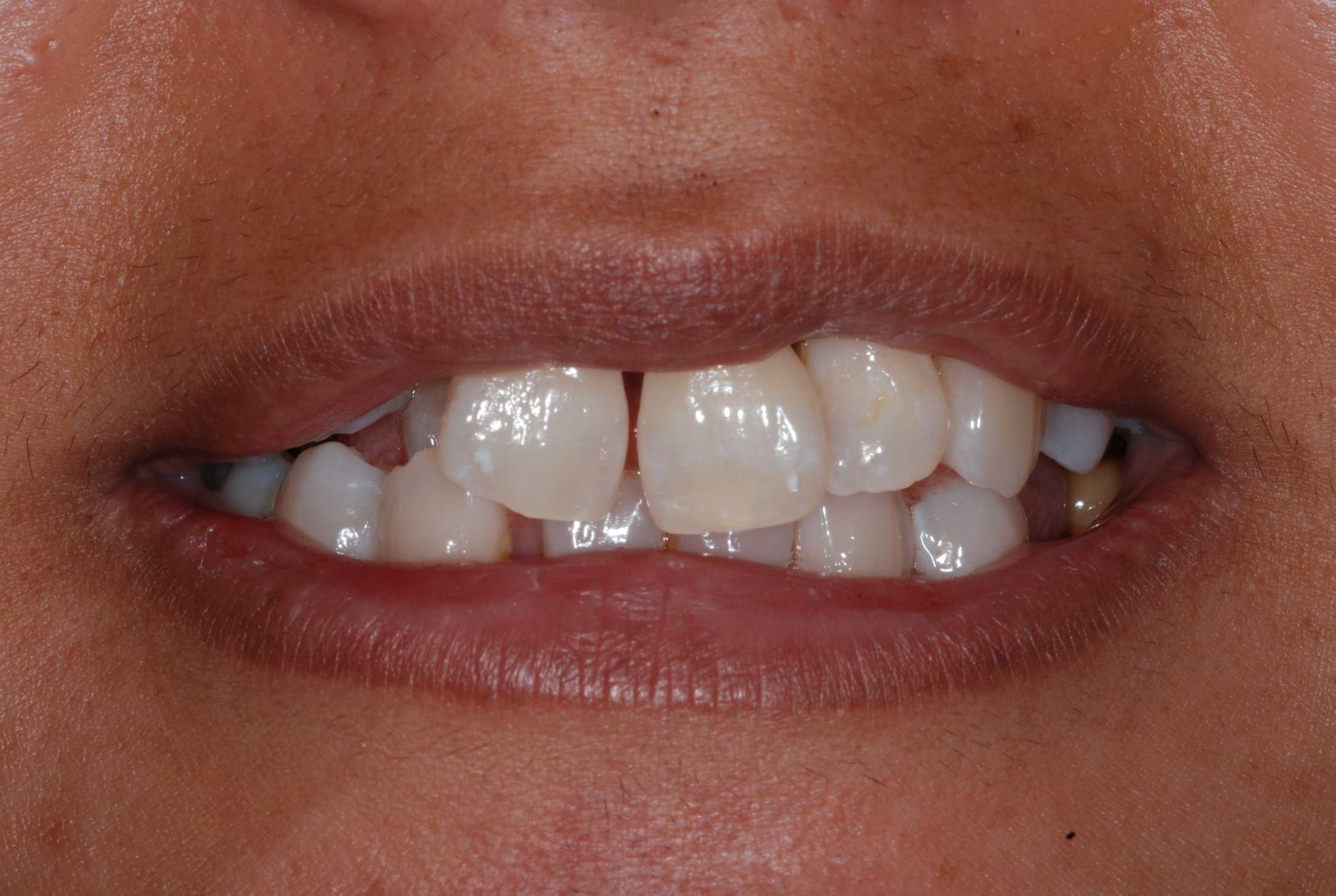 Before a Bridge example of missing teeth