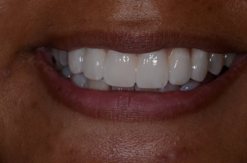 Patient's smile after a dental bridge
