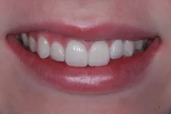 up-close image of patient's smile after dental treatment