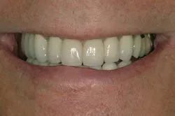 up-close image of patient's smile after dental treatment