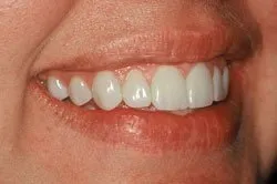 up-close image of patient's smile after dental treatment