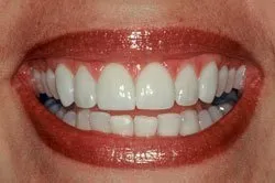 up-close image of patient's smile after dental treatment