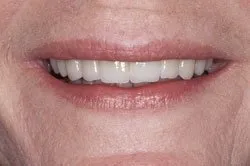 patient's smile after dental treatment