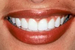 patient's smile after dental treatment
