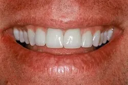patient's smile after dental treatment