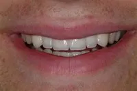 Patient's smile after dental bridges