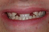Patient's smile before dental bridges