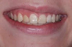 up-close image of patient's smile before dental treatment