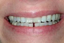 patient's smile before dental treatment