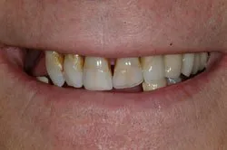 up-close image of patient's smile before dental treatment