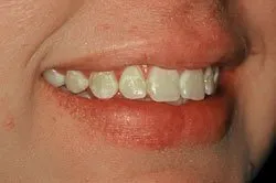 up-close image of patient's smile before dental treatment