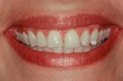 up-close image of patient's smile before dental treatment
