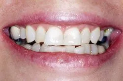 patient's smile before dental treatment