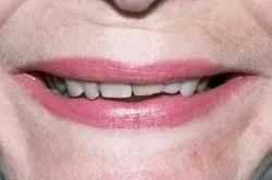patient's smile before dental treatment