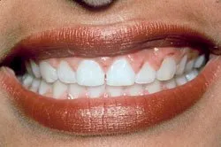 patient's smile before dental treatment