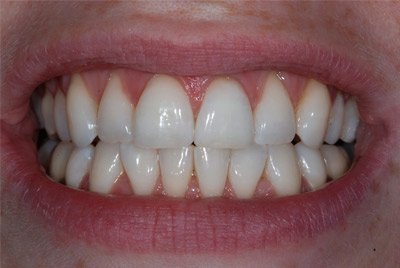 Internal Bleaching by Dr. Anderson