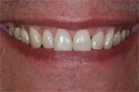 Patient's smile after cosmetic bonding