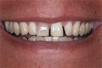Patient's smile before cosmetic bonding