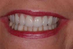 up-close image of patient's smile after dental treatment