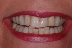 up-close image of patient's smile before dental treatment