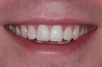 Patient's smile after cosmetic bonding
