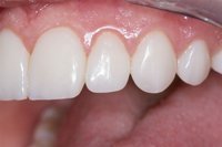 Patient's teeth after cosmetic bonding