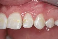 Patient's teeth before cosmetic bonding