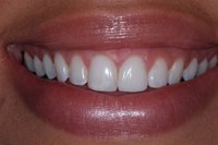 Patient's smile after direct veneers