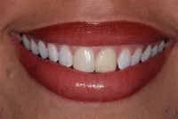 Patient's smile before direct veneers