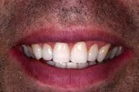 Patient's smile after cosmetic bonding