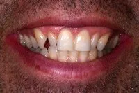 Patient's smile before cosmetic bonding