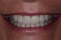 Patient's smile after dental crowns
