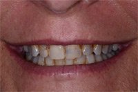 Patient's smile before dental crowns