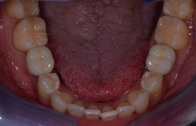 Patient's bottom teeth after dental implants