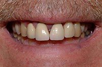 Patient's smile with teeth affected by gum disease before dental implants supporting custom bridges