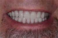 Patient's smile after implant-supported dentures