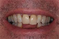Patient's smile before implant-supported dentures