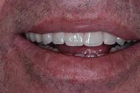 Patient's smile after implant-supported dentures