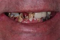 Patient's smile before implant-supported dentures