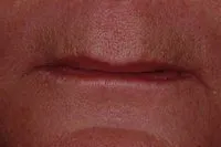 Patient's mouth before implant-supported dentures